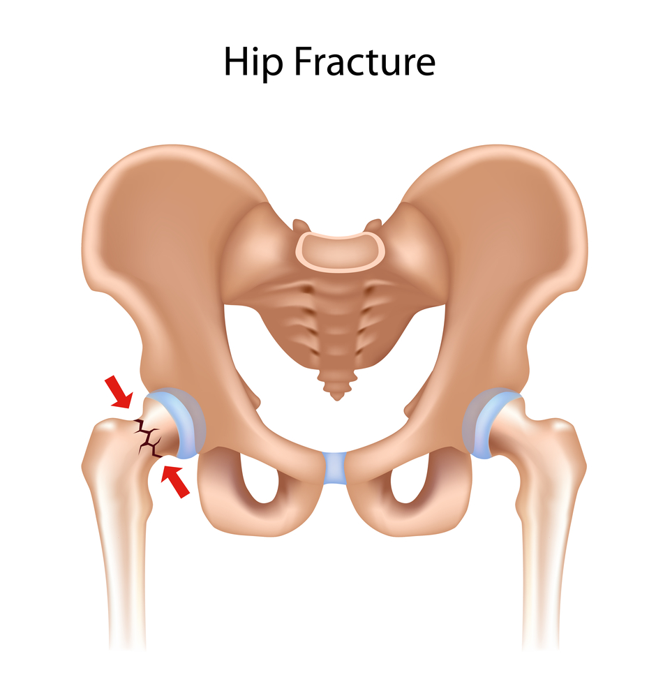 hip fracture.jpg